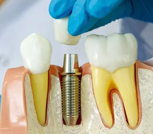 implant