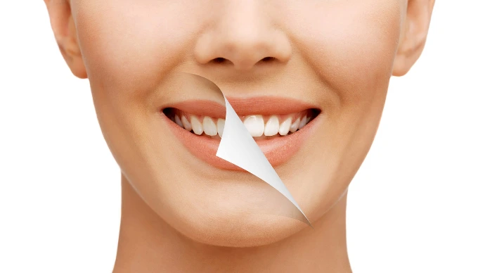 Smile makeovers