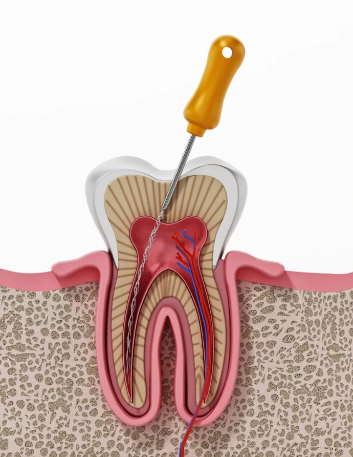 root canal